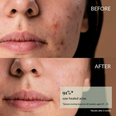 IREN Shizen  [Duo Set] CLEARER DAYS Anti-Blemish Serum 5