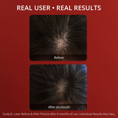 Breo Trilogy Scalp 3L Scalp Massager 3