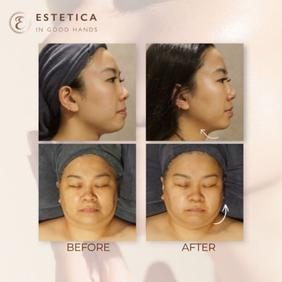 Estetica 60-Min Intensive Ultight + TriPollar V-Lift Therapy 3